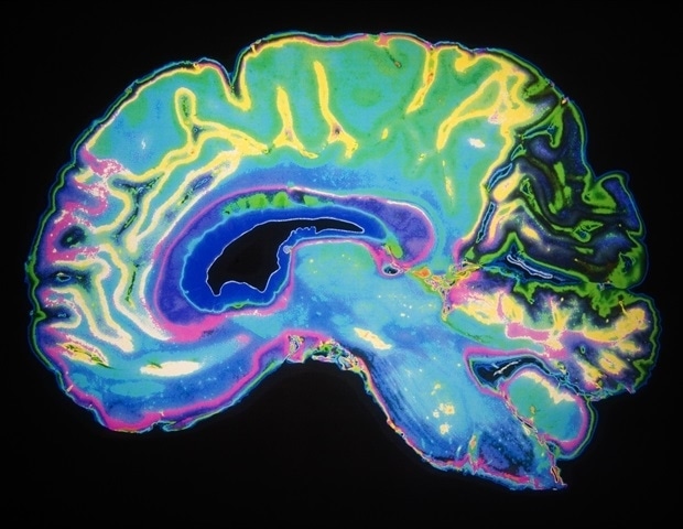 Researchers discover glioblastoma origins using brain organoids