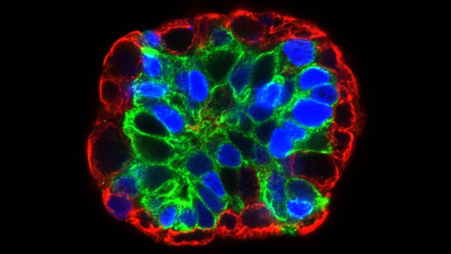 Organoids: Exploring Liver Cancer Initiation and the Possibilities of Personalized Glioblastoma Treatment